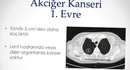 Akciğer Kanseri 1 Evre Yaşam Süresi