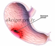 Akciğer Kanseri Tedavisi Akciğer Kanseri Nasıl Tedavi Edilir