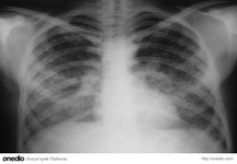 Silikosiz Nedir? Belirtileri ve Tedavisi