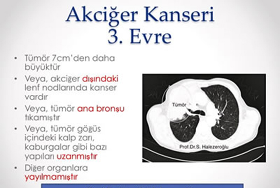 3 Evre Akcier Kanseri