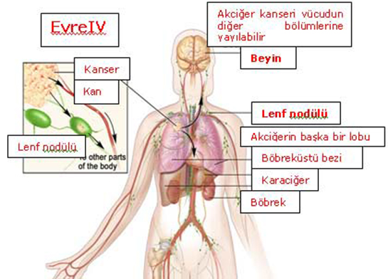 4 Evre Akcier Kanseri