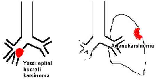 Adenokarsinom Akcier Kanseri