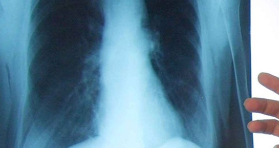 Akciğer Hastalıklarından Korunma Yolları