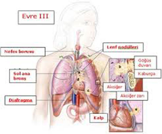 Akciğer Kanseri Çeşitleri