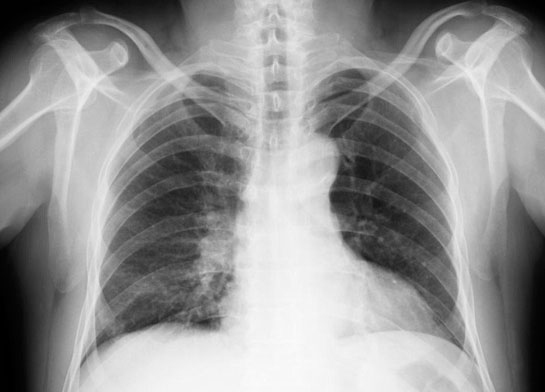 Akciğer Kanseri Metastaz