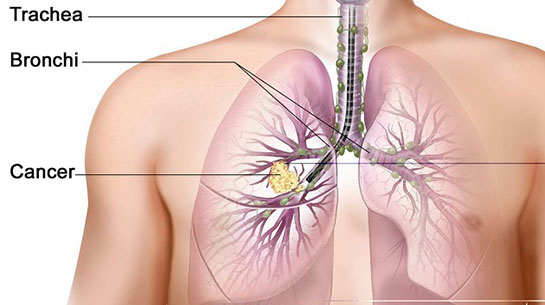 Akciğer Kanseri Testi
