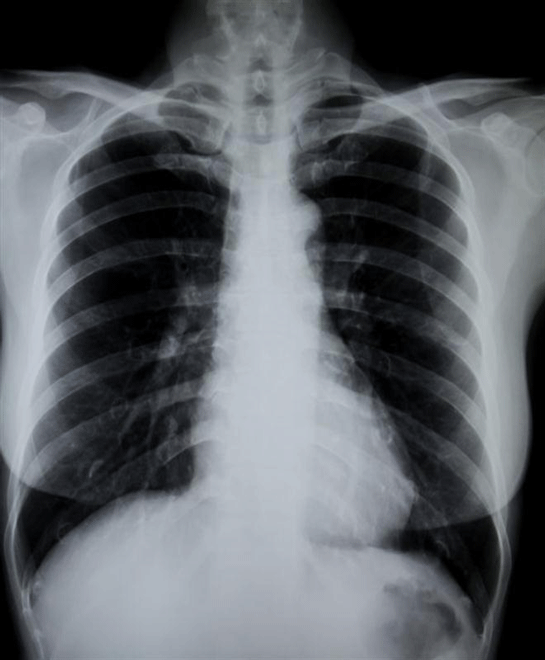 Akciğer Tomografisi