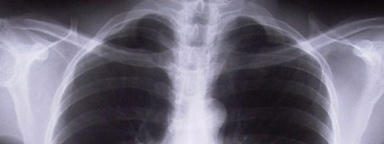 Akciğer Tüberkülozu