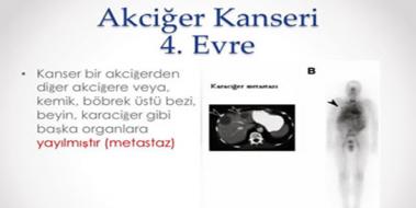 Akcier Kanseri 4 Evre